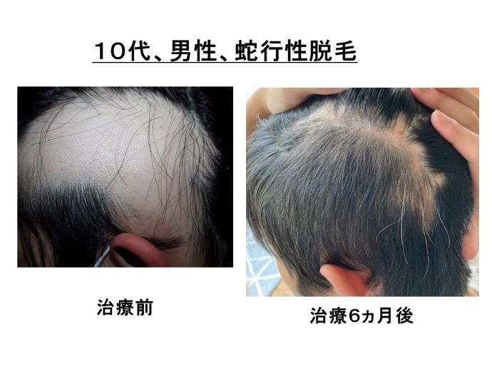 円形脱毛症　病院